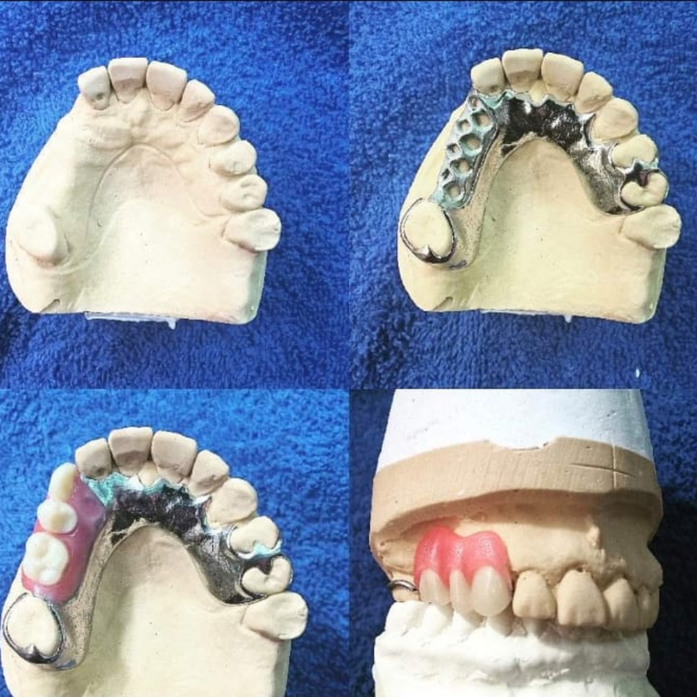 Four stages of a chrome cobalt partial denture on a working cast