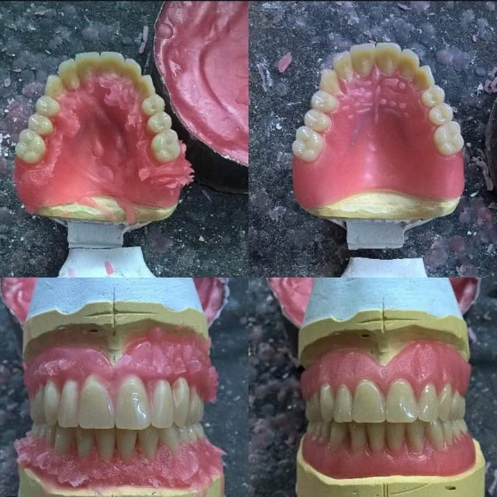 Four views showing a denture tryin before and after finishing