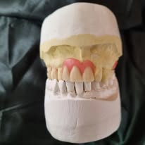 Anterior set-up