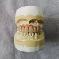 Lower anterior