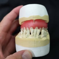 Partial denture